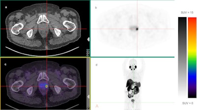 A 70-year-old male with unfavorable intermediate-risk prostate cancer (ISUP grade 3; PSA 5.2 ng/mL) who underwent F-18 PSMA-1007 PET/CT that showed a solitary F-PSMA-avid focus within the left midposterolateral prostate gland (SUVmax 14.9). (a) Axial noncontrast CT, (b) axial PET attenuation corrected image, and (c) axial fused PET/CT image at the level of the prostate gland. (d) maximum intensity projection (MIP) image. Image courtesy of EJNMMI Research.