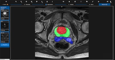 The qp-Prostate software at work. Image courtesy of Quibim.