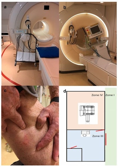 Examples of MRI accidents. (A) A trolley is stuck on the magnet. (B) A patient monitor is stuck on the magnet. (C) A patient experienced a blister in the groin. (D) Safety zone II is missing (the red lines represent the three doors to the unit). Images courtesy of Johan Kihlberg, PhD, and colleagues and European Radiology.