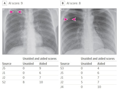 (Panel A) Artificial intelligence (AI) helped detect right upper lobe nodules (arrowheads) for three junior (J) radiologists, as well as improved the confidence score for one senior (S) radiologist (score > 5 implies positive finding). Likewise, AI-aided interpretation led to detection of missed right upper lobe nodules (arrowheads) for the radiograph in panel B for two junior radiologists and improved confidence of two junior radiologists. Image courtesy of JAMA Open Network.