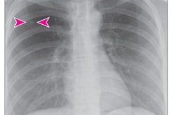 2022 01 04 17 37 3989 2022 01 04 Ai Rad Companion Cxr 400