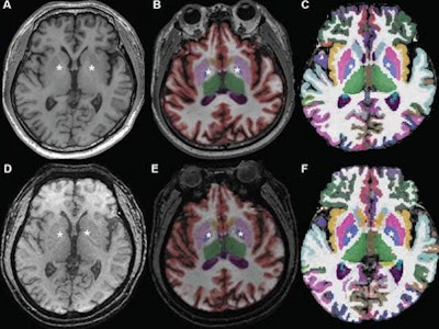 Axial MR images at basal ganglia in a 63-year-old woman with subjective cognitive impairment. Conventional 3D T1-weighted image (A) without segmentation, (B) with segmentation by Neuroquant software, and (C) with segmentation by Freesurfer software; ultrafast 3D-EPI T1-weighted image (D) without segmentation, (E) with segmentation by Neuroquant, and (F) with segmentation by Freesurfer. Pallidum (asterisks) appears larger for Freesurfer (C, F) than for NeuroQuant (B, E), but appears similar in size between two sequences for each software package. For both software packages, bilateral frontal and occipital cortices (B, C) at bone-tissue interface appear more color-coded for conventional than for ultrafast sequence, contributing to larger cortical gray matter for conventional sequence. All images and caption courtesy of the American Journal of Roentgenology.