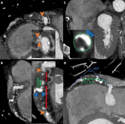 Images from coronary CT angiography for chronic total occlusion (CTO) in a 55-year-old man who presented with chest pain. (A-C): Oblique reformatted CT images show an occlusion in the proximal to mid with segment of right coronary artery. Long-segment CTO (green dashed line) measuring 47.2 mm tapered tip stump (orange arrowheads) and mild tortuosity. Calcification (blue arrowheads) involving less than 50% of the vessel cross-sectional area within the occlusion site (green dashed circle). Presence of two complete interruptions (double red arrows) of the contrast opacification separated by contrast-enhanced segment of greater than 5 mm (double green arrow). (D) Maximum intensity projection image shows presence of bending of greater than 45 degrees within the occlusion route (blue dotted lines). Green dashed line indicates coronary course. Images and caption courtesy of the RSNA.