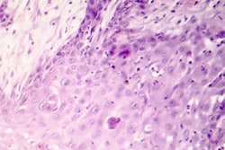 2022 01 07 23 23 0857 Cutaneous Squamous Cell Carcinoma Skin 400
