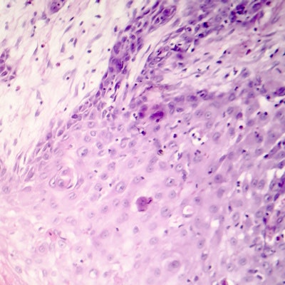 2022 01 07 23 23 0857 Cutaneous Squamous Cell Carcinoma Skin 400