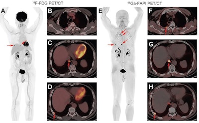 Images of a 56-year-old man with lung adenocarcinoma for tumor restaging after treatment. (A) Maximum intensity projection F-18 FDG image, and (B-D) axial fused F-18 FDG PET/CT images of upper chest and upper abdomen. (E) Maximum intensity projection Ga-68 FAPI image and (F-H) axial fused Ga-68 FAPI PET/CT images of upper chest and upper abdomen. Ga-68 FAPI PET/CT images depict four positive lesions (arrows) in the right pleura with intense tracer uptake (SUVmax: 4.9 to approximately 12.8). F-18 FDG PET/CT images only depict two positive lesions in the right pleura with a slightly lower tracer uptake (arrows in A, C, and D; SUVmax: 8.5-10.4). Image courtesy of Radiology.