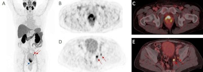 A 72-year-old patient with high-risk prostate cancer (iPSA 44 ng/mL) who underwent F-18 rhPSMA-7.3 PET/CT illustrating the primary tumor (blue arrow) and pelvic lymph node metastases (red arrows) histologically confirmed by radical prostatectomy (pT3b pN1 (2/34), Gleason score 3 + 4 = 7b); (A) maximum intensity projection (MIP), (B, C) PET, (D, E) fused PET/CT images. Image courtesy of the Journal of Nuclear Medicine.