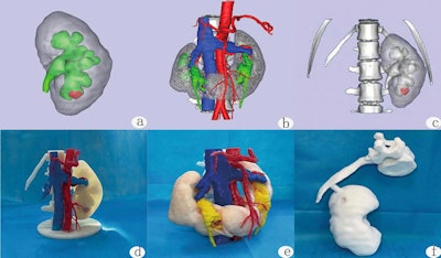 Puncture training and postoperative plain film. (a) Selection of puncture sites and calyces in a 3D reconstruction image; (b,c) puncture training, target calyces, selection of puncture angle, and estimation of puncture depth on 3D-printed physical model. (d) Postoperative plain film. Images and caption courtesy of Dong Cui, Fengqi Yan, JiangPu Yi, et al, and Scientific Reports through Creative Commons Attribution 4.0 International License.