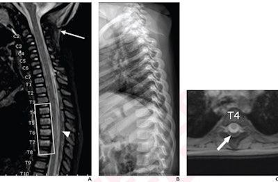 A 16-month-old boy, born at gestational age of 28 weeks, who presented with unexplained facial burns. He also had unexplained rib, humerus, and tibial fractures, three skull fractures, severe acute hypoxic brain injury with transtentorial herniation, and intracranial subdural hematoma in the interhemispheric falx and the tentorium. The child was diagnosed with abusive head trauma. (A) Sagittal STIR image from whole-spine MRI demonstrates edema in the nuchal ligament consistent with ligamentous injury (arrow) and epidural hematoma extending along the thoracic spine (arrowhead), associated with compression fractures from T4 to T7 (rectangle). Epidural hematoma is isolated to thoracolumbar spine. (B) Lateral radiograph of the thoracic spine was clinically interpreted as negative for spine fracture. (C) Axial gradient-recalled echo T2-weighted MR image at L4 demonstrates posterior hematoma obliterating the epidural fat, consistent with epidural hematoma (arrow). Image courtesy of the American Journal of Roentgenology.