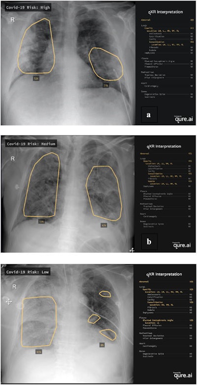 Examples of chest radiographs evaluated by the M-qXR algorithm. M-qXR assigned a high (a), medium (b), and low (c) COVID-19 risk score based on the presence of radiographic abnormalities on the chest radiographs presented. Images and caption courtesy of D. Hipolito Canario et al and Intelligence-Based Medicine through Creative Commons Attribution 4.0 International License.