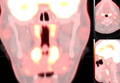 FDG uptake on PET/CT in nasal-associated lymphoid tissue in a cancer patient infected with the COVID-19 omicron variant. Image courtesy of Dr. Munir Ghesani.