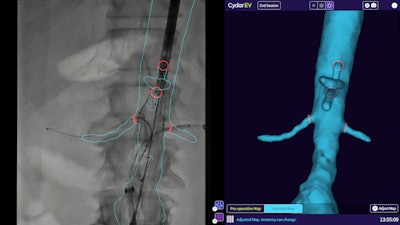 Cydar EV Maps software supports planning, real-time 3D image guidance, and postprocedure review of endovascular surgeries. Image courtesy of Philips Healthcare.