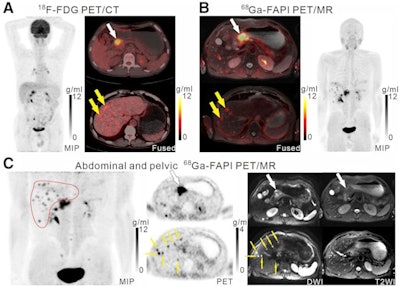 A 61-year-old man with moderately differentiated gastric adenocarcinoma. In addition to the primary tumor (A, white arrow, SUVmax = 11), two foci of elevated activity in the liver were noted on the F-18 FDG PET/CT images (A, yellow arrows, SUVmax = 5.8). On the Ga-68 FAPI PET/MR images, the primary tumor had more intense uptake (B and C, white arrows, SUVmax = 14.2), and the two hepatic lesions had more prominent Ga-68 FAPI accumulation (B, yellow arrows, SUVmax = 7.6). Also, multiple foci of increased Ga-68 FAPI activity were also revealed in the liver (C, red outline, yellow arrows), which corresponded to multiple high signals on diffusion-weighted imaging (yellow arrows), suggesting multiple hepatic metastases. Image courtesy of the Journal of Nuclear Medicine.