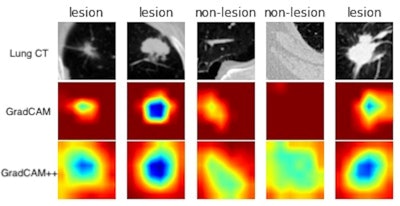 MONAI provides Class Activation Mapping (CAM), gradient-weighted CAM (Grad-CAM), and Grad-CAM++ application programming interfaces for both 2D and 3D models. The above example is generated by computing Grad-CAM and Grad-CAM++ from a lung CT lesion classification model. Image courtesy of Nvidia.