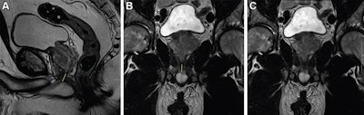 T2-weighted fast spin-echo MRI scans in (A) sagittal view and (B, C) coronal views with (B) and without (C) annotation illustrate the membranous urethra length (MUL) measurement technique. MUL was defined as the distance from the prostate apex to the urethral entry into the penile bulb. The yellow line in A and B represents the MUL. Images courtesy of Radiology.