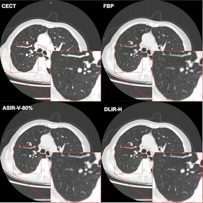 Chest CT images from deep learning image reconstruction (DLIR) and adaptive statistical iterative reconstruction-V (ASIR-V) compared with contrast-enhanced chest CT (CECT). A 72-year-old man had a body mass index of 19.0 kg/m2, with a clinical history of lung cancer surgery in the right middle lobe five years prior. The four images include a CECT image (reconstructed with use of ASIR-V level 50%) as the reference and filtered back projection (FBP), ASIR-V level 80% (ASIR-V-80%), and high-strength DLIR (DLIR-H) images at 0.14-mSv ultralow-dose CT. The red outlined areas show the details of the magnified images of lung parenchyma. The DLIR-H image shows clearer lung parenchyma and more details than the ASIR-V-80% image, similar to the CECT image. Image and caption courtesy of the RSNA.