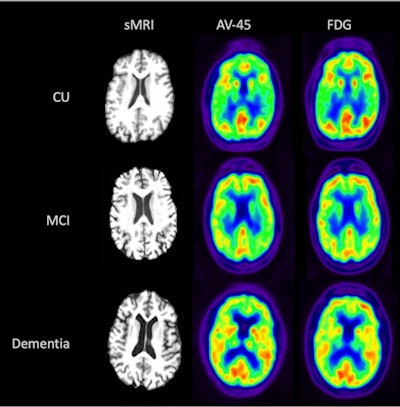 Visual comparison of sMRI, early-frame F-18 florbetapir, and F-18 FDG-PET for participants from each disease state (CU, MCI, and dementia). Image courtesy of the Journal of Hybrid Imaging.