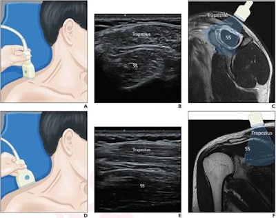 (A) A 37-year-old male patient is in a supine and neutral position, with his neck muscle gently stretched and head turned slightly to the contralateral side. The ultrasound transducer is initially placed with application of minimal pressure. (B) The supraspinatus and trapezius muscles are identified in the transverse plane. (C) The view is represented using a sagittal T2-weighted MR image. (D) The transducer is turned to the longitudinal view. (E) Supraspinatus and trapezius muscles are visualized along longitudinal orientation of muscle fibers. (F) View is represented using a coronal T2-weighted MR image. SS = supraspinatus