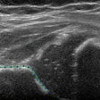 2022 01 25 22 46 4617 2022 01 26 Rsna Ultrasound Hip