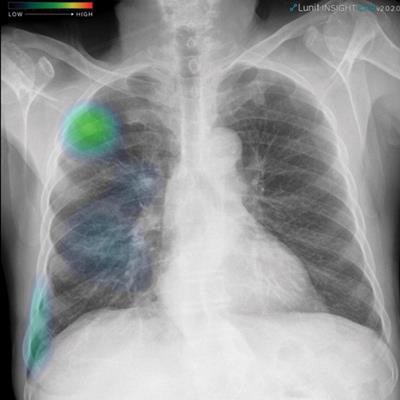 2022 01 30 20 57 5212 2022 01 31 Pneumothorax Cxr 20220130201223