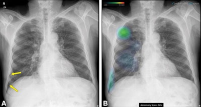 Follow-up chest x-ray in a 68-year-old man after percutaneous transthoracic needle biopsy for a nodule in the right upper lobe. (A) Original image shows a small pneumothorax developed in the right lower pleural space (arrows). (B) Additional image with an overlaid heat map from the AI algorithm highlights the location of the nodule and pneumothorax, which was in an unusual spot and could have been missed. Image courtesy of Radiology.