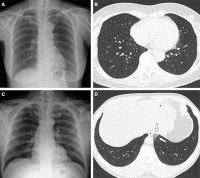 Representative cases showing extent and pattern of pneumonia on chest x-ray (CXR) and CT images. (A and B) A 65-year-old female with breakthrough infection two months after a second dose of the Pfizer vaccine (fully vaccinated). The patient had a history of hypertension. (A) Chest x-ray obtained at admission showing no abnormal opacification in both lung zones. The extent of pneumonia on the chest x-ray was scored as 0 (no evidence of pneumonia). (B) Axial chest CT image at the lower lobe level (obtained on the same day) showing patient negative for pneumonia; CT extent of pneumonia was scored as 0 (no evidence of pneumonia). (C and D) A 48-year-old male with one month after a first dose of the AstraZeneca vaccine (partially vaccinated). The patient had no history of comorbidity. (C) Chest x-ray obtained at admission showing no abnormal opacification in both lung zones. The extent of pneumonia on chest x-ray was scored as 0 (no evidence of pneumonia). (D) Axial chest CT image obtained on the same day showing unilateral ground-glass opacity with a nonrounded morphology in the left lower lobe (arrows). CT extent of pneumonia was scored as 1 (1% to 25% involvement) and this case was classified as indeterminate appearance of COVID-19 according to the RSNA chest CT classification system. Images and caption courtesy of the RSNA.