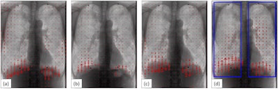 A 65-year-old male COPD patient with 38.5 FEV1% and percent predicted %FEV1 16.3, which meets the criteria of severe COPD. Blue rectangles (d) represent bilateral regions of interest. VF-DXR images in (a) tidal inspiratory, (b) tidal expiratory, (c) forced inspiratory, and (d) forced expiratory phase. (e) The graph shows the temporal change between LMV in the right lung and the number of frames. The frame rate is set to 5 frames/s (Video 2 in the Supplemental material). Images courtesy of European Radiology Experimental.