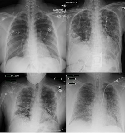 (A) RT-PCR-negative case in which both readers agreed the case was normal. (B) RT-PCR-negative case in which readers disagreed, with one reader labeling COVID-19 and the other labeling Other - Infectious. (C) RT-PCR-positive case in which both readers agreed on COVID-19. (D) RT-PCR-positive case in which readers disagreed, with one reader labeling COVID-19 and the other labeling Other - Noninfectious. Image courtesy of Clinical Imaging.