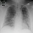 2022 02 02 00 09 3090 2022 02 03 Cxr Covid 19 20220202005447