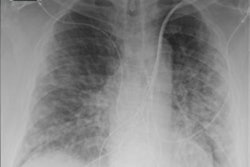 2022 02 02 00 09 3090 2022 02 03 Cxr Covid 19 20220202005447