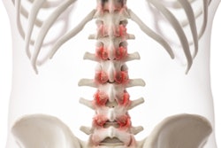 2022 02 02 23 31 1840 3d Rendered Arthritic Lumbar Spine 400