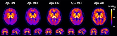 Representative transaxial, coronal, and sagittal F-18 SMBT-1 PET images of study participants: (from left) beta amyloid-negative cognitively normal (CN), beta amyloid-negative mild cognitively impaired (MCI), beta amyloid-positive CN, beta amyloid-positive MCI, and beta amyloid-positive with Alzheimer's disease. In beta amyloid-negative CN and MCI, the normal distribution of F-18 SMBT-1 in the brain is observed, highlighting cortical areas with high concentration of MAO-B, such as the basal ganglia, thalamus, mesial temporal cortex, and anterior cingulate, as well as the different nuclei in the brainstem. Higher cortical F-18 SMBT-1 binding is observed in beta amyloid-positive CN, MCI and Alzheimer's disease participants, with binding extending to frontal, temporal, occipital, and posterior cingulate. Image courtesy of the Journal of Nuclear Medicine.