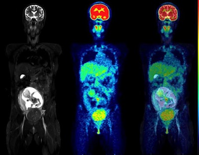 Coronal slices of MRI (left), PET (center), and fused PET/MRI (right) of a woman at 18 weeks of pregnancy. Of particular interest is the level of uptake in the fetal organs. While the heart showed high F-18 FDG uptake, the brain had only a low level of glucose consumption, especially compared with brain uptake of the mother. This pattern of low glucose consumption has previously been noted even in mature fetuses. All images courtesy of the Journal of Nuclear Medicine.