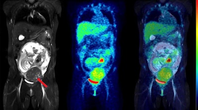 Coronal slices of MRI (left), PET (center), and fused PET/MRI (right) of the same woman as above, but at 24 weeks of pregnancy. The fetus has visibly increased in mass, but the pattern of F-18 FDG uptake in the organs has not changed, with the heart showing high glucose consumption but the brain still largely silent. The red arrow points to a uterine fibroid.
