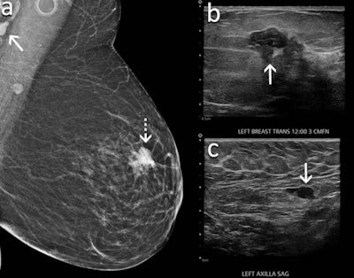 A 60-year-old woman underwent screening mammography nine weeks after receiving her second dose of the Moderna COVID-19 vaccine. (A) Mediolateral oblique view of the left breast shows an irregular mass in the superior left breast (dash arrow) and a dense lymph node in the left axilla that is incompletely visualized (arrow). Sonography meanwhile showed (B) an irregular hypoechoic mass in the breast (arrow) that corresponded to the mammographic finding and (C) a lymph node with eccentric cortical thickening measuring 6 mm (arrow) in the axilla. Biopsy of the mass showed invasive ductal carcinoma and biopsy of the lymph node showed metastatic carcinoma. Image courtesy of RSNA.
