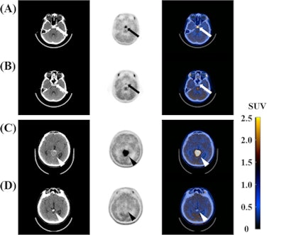 Noncontrast CT, MET-PET, and fusion images of two representative cases in patients with intracranial germinomas before and after treatment. (A, B) The first case was an 11-year-old boy who experienced headache, polydipsia, polyuria, and growth hormone deficiency before treatment. The primary tumor was located in the sellar-suprasellar region (white and black arrows). Before treatment, pre-Tx SUVmax and pre-Tx T/N ratio were 4.91 and 4.38. After chemotherapy and radiation therapy, post-Tx SUVmax and post-Tx T/N ratio decreased to 1.62 and 1.27. The visual grade was 3 before the treatment and decreased to 2 after treatment. (C, D) The second case was a 14-year-old boy who experienced headache before treatment. The primary tumor was located in the pineal region (white and black arrowheads). Before treatment, pre-Tx SUVmax and pre-Tx T/N ratio were 4.95 and 3.96. After chemotherapy and radiation therapy, post-Tx SUVmax and post-Tx T/N ratio decreased to 1.52 and 1.15. The visual grade was 3 before treatment and then decreased to 1 after treatment. Image courtesy of PLOS One.