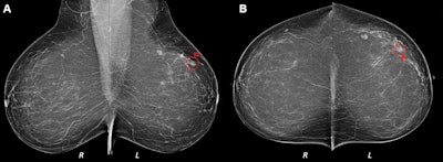 (A) Mediolateral oblique and (B) craniocaudal digital mammograms interpreted as clinically normal in a 52-year-old woman. Artificial intelligence (AI) identified an architectural distortion (◯) on both images and assigned region scores of 92 in A and 84 in B. AI score was 10, indicating the highest risk category. Breast density was computed as 15. A 4-mm invasive lobular carcinoma was diagnosed in the left breast 9 months after screening mammography but before the next screening round. All images courtesy of the RSNA.