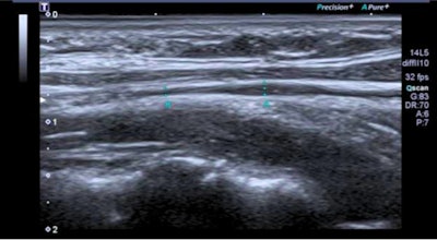 Spanish research has found possible links between long COVID and vagus nerve dysfunction in patients. Ultrasound images show (Above) longitudinal section of the left vagus at the cervical level, where there is a slight fusiform thickening, and (Below) an axial cut of left cervical vagus showing hyperechogenic perineural thickening. Images courtesy of Dr. Gemma Lladós et al.