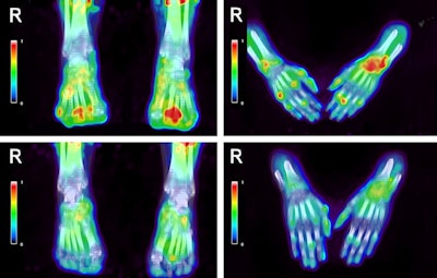 Decrease of R-(C-11) PK11195 uptake in the hand and feet joints of a patient with rheumatoid arthritis (RA) with polyarthritis, before (top) and two weeks after initiation of COBRA light treatment (bottom). Image courtesy of Rheumatic and Musculoskeletal Diseases.