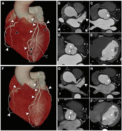 Images from (A-E) coronary photon-counting CT and (F-J) energy-integrating detector dual-layer CT angiography in a 44-year-old woman. Volume-rendered photon-counting CT image (A) and volume-rendered energy-integrating detector dual-layer CT image (F) depict proximal coronary arteries (white arrowheads), but there is clear improvement in the depiction of distal coronary arteries (black arrowheads in A) with volume rendering and photon-counting CT in comparison to energy-integrating detector dual-layer CT. On axial images, pectinate muscle (B, G), aortic cusp commissure (C, H), noncoronary cusp (D, I), and papillary muscle (E, J) were better depicted on photon-counting CT images (B-E) than on energy-integrating detector dual-layer CT images (G-J) (white arrowheads). Black arrowheads indicate distal coronary arteries not depicted on energy-integrating detector dual-layer CT images. Images and caption courtesy of the RSNA.