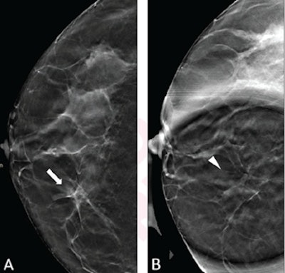 (A) Standard DBT craniocaudal view shows asymmetry (arrow) in medial right breast. (B) DBT spot compression view shows asymmetry does not persist (arrowhead). Three readers classified the lesion with and without spot compression, respectively, by the following: BI-RADS category 4a and 2 by reader 1, category 4a and 2 by reader 2, and category 4b and 2 by reader 3. Follow-up imaging at one year showed stability of spot compression findings, consistent with being benign in the present analysis. Image courtesy of the American Journal of Roentgenology.