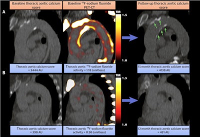 Relationship between thoracic aortic F-18 sodium fluoride activity and progression of thoracic aortic calcium score (Agatston units). (A) Example case in which intense F-18 sodium fluoride activity on PET/CT precedes areas of macrocalcification on CT. (B) Example case of low F-18 sodium fluoride activity and minimal progression of macrocalcification on computed tomography. Image courtesy of JACC: Cardiovascular Imaging.