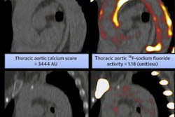 2022 02 23 00 49 8641 2022 02 24 Pet Aorta Plaque 20220223004513