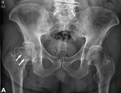 A radiograph showing a single true-positive fracture of the right femoral neck (arrows). This fracture was detected by AI using the FRACT threshold (box). The fracture was missed by one senior and one junior radiologist, two emergency department physicians, one physician assistant, three rheumatologists, and one family medicine physician. All readers pointed out the fracture with the assistance of AI. Image courtesy of Radiology.