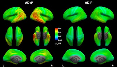 Cortical uptake of flortaucipir F-18 tracer in the form of SUVR referenced to whole cerebellum cortex for each group in the study: Alzheimer's disease/psychotic-positive (P+) and Alzheimer's disease/psychotic-negative (-P). The top row displays lateral planes of the brain, the middle row superior and inferior planes, and the bottom row medial planes. Image courtesy of Translational Psychiatry.