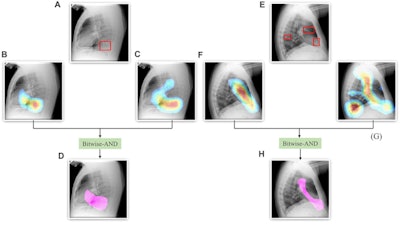A Bitwise-AND ensemble generated using the heatmaps produced by the top two performing models, VGG-16 and DenseNet-121 models. (A) and (E) Sample test lateral chest x-rays with expert ground truth annotations (shown in red bounding box); (B) and (F) heatmaps produced by the VGG-16 model; (C) and (G) heatmaps produced by the DenseNet-121 model, and (D) and (H) mask resulting from the Bitwise-AND operation of the heatmaps produced by the VGG-16 and DenseNet-121 models. Image and caption courtesy of Sivaramakrishnan Rajaraman, PhD, et al and Frontiers in Genomics through Creative Commons Attribution 4.0 International License.