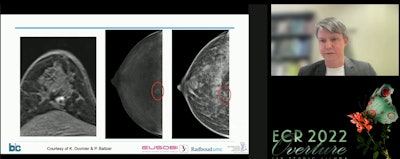 Dr. Ritse Mann, PhD, threw his support for breast MRI in a special 'pros and cons' debate session at the ECR Overture on March 2. Citing previous research, Mann pointed to MRI's high sensitivity and cost-effectiveness, as well as contrast-enhanced mammography's inherent risks for patients.