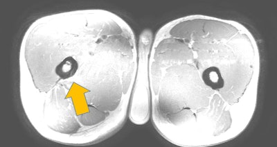 Posteromedial stress fracture in right femur in long distance marathon runner. Image courtesy of Dr. Gino Kerkhoffs, PhD, and Dr. Mario Maas.