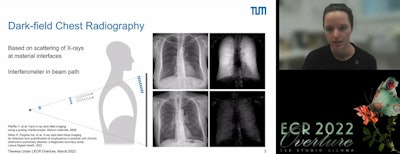 Doctoral candidate Theresa Urban of the Technical University of Munich presented the first clinical trial evidence evaluating dark-field chest radiography during ECR 2022 Overture.