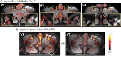(a) Axial images with inset magnification of bilateral inguinal lymph nodes on imaging day 3 for a viremic (V3), ART-suppressed (A1), and uninfected control (C3). (b) Axial image of persistent inguinal lymph node Zr-89 VRC01 uptake in inguinal lymph nodes on imaging day 0 (6 hours post injection), and imaging day 3 (72 hours post injection). Image courtesy of Nature Communications.
